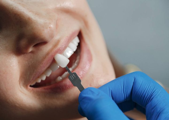 Lamine Diş mi Porselen Kaplama mı?