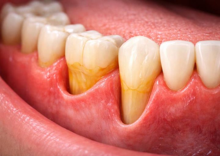Diş Eti Çekilmesi Neden Olur? Tedavisi Var mı?