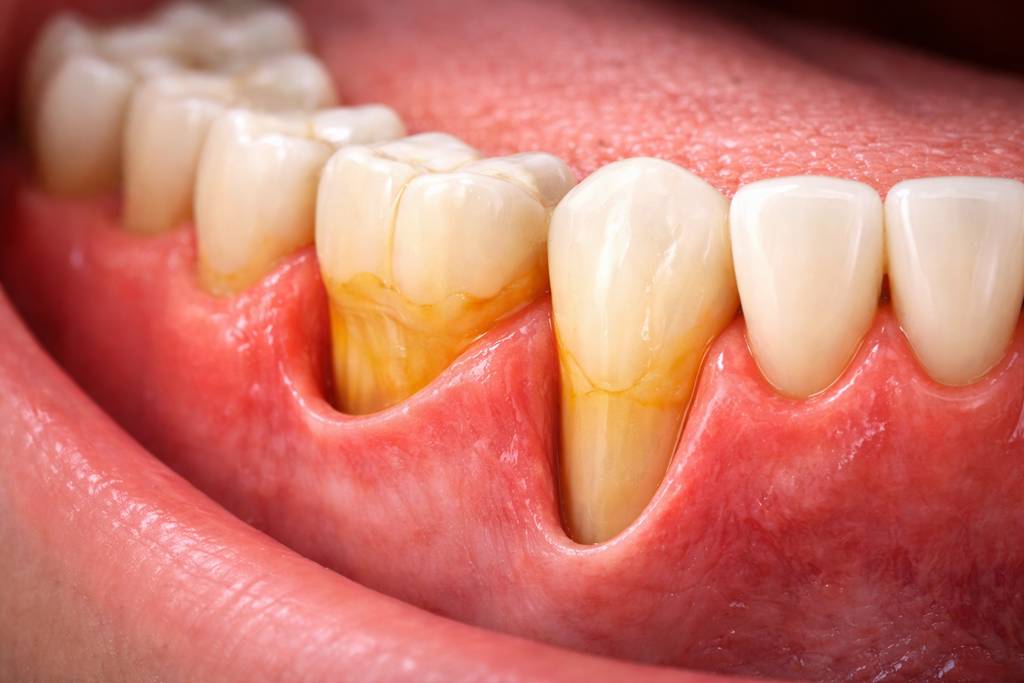 Diş Eti Çekilmesi Neden Olur? Tedavisi Var mı?