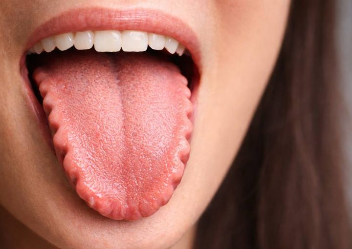 Tırtıklı Dil Neden Olur? Tehlikeli mi?