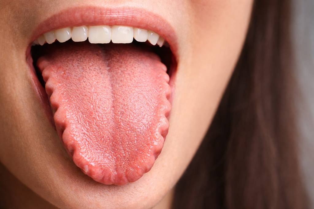 Tırtıklı Dil Neden Olur? Tehlikeli mi?